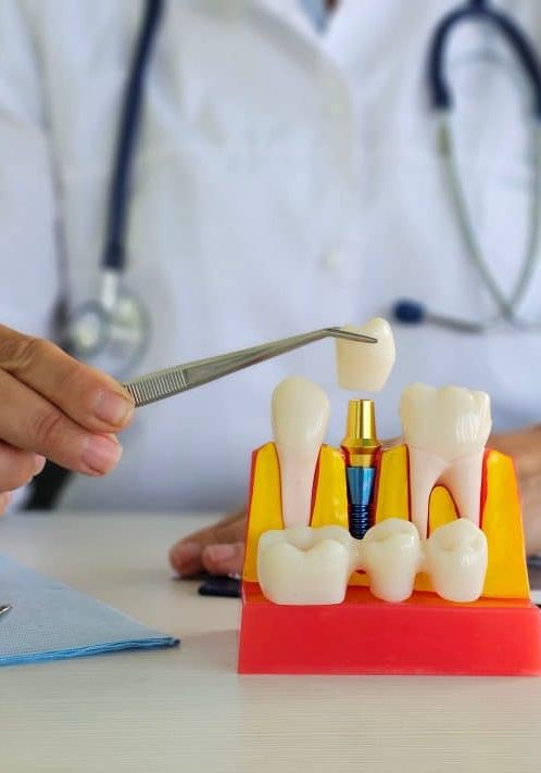 dental implants Sunnyvale